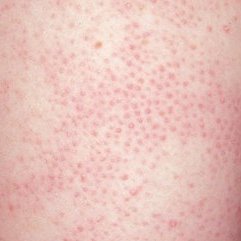 Slideshow: Boils and the Skin - WebMD